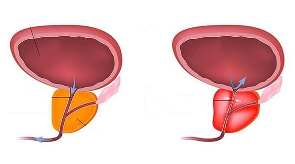 healthy and inflammatory protector with prostatitis